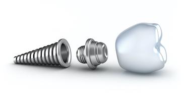 Diagram of tooth with dental implant, downey ca