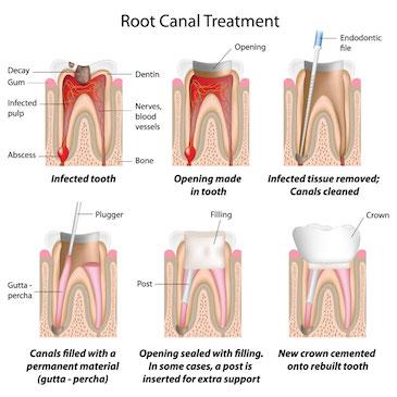 Diagram explaining how root canal treatments work, Downey CA