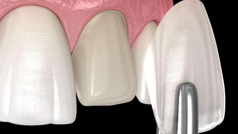 Image of veneer being placed on a tooth, downey ca