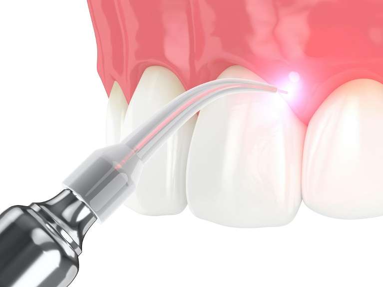 Diagram of laser cavity detection tool being used on teeth, Downey CA